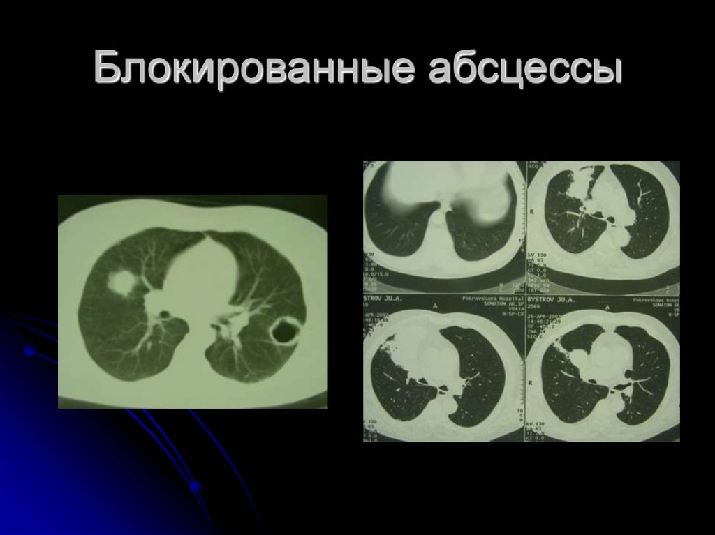 Блокированные абсцессы
