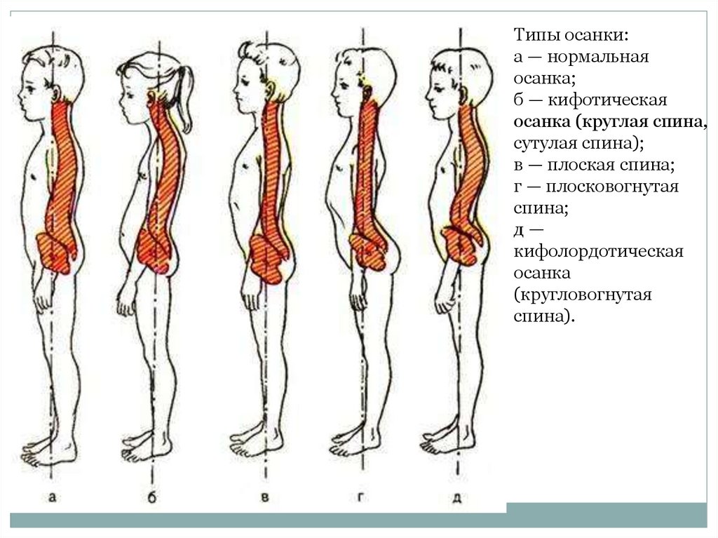 Виды кифоза позвоночника