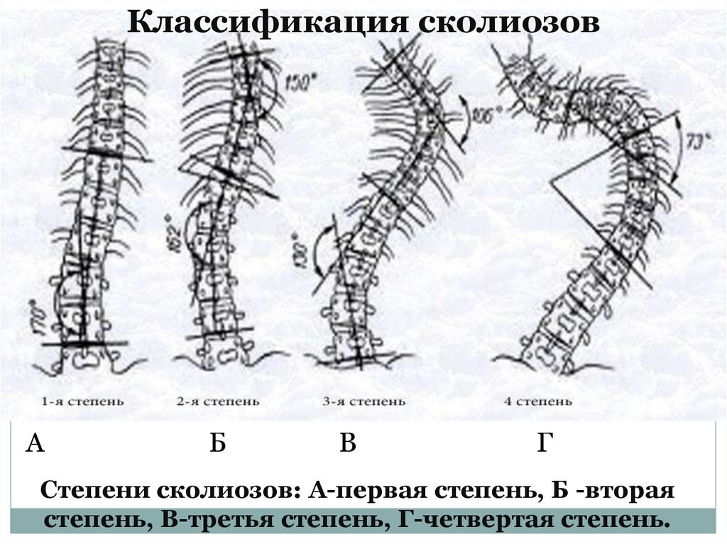 Степени сколиоза