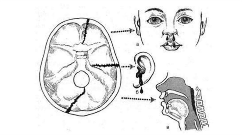 Перелом основания свода. Ликворея при переломе основания черепа. Перелом свода основания черепа. Переломы основания черепа передней черепной ямки. Перелом основания черепа механизм.