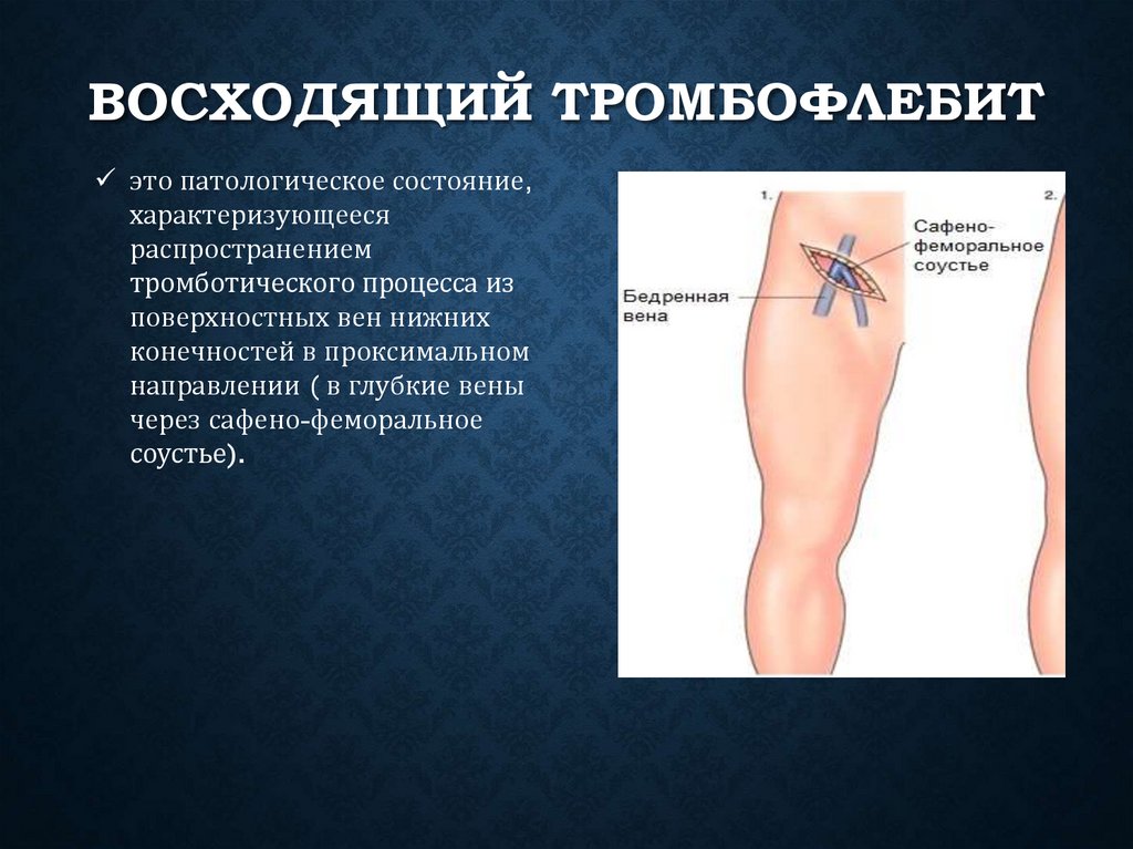 Клиническая картина тромбозов. Флебит поверхностных вен. Тромбоз поверхностных вен. Острый поверхностный тромбофлебит.