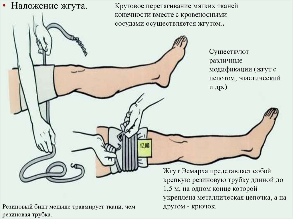 Кровоостанавливающий жгут при артериальном кровотечении. Техника наложения жгута Эсмарха. Наложение жгута Эсмарха при кровотечении алгоритм. Техника наложения артериального жгута Эсмарха.. Техника наложения жгута Эсмарха алгоритм.