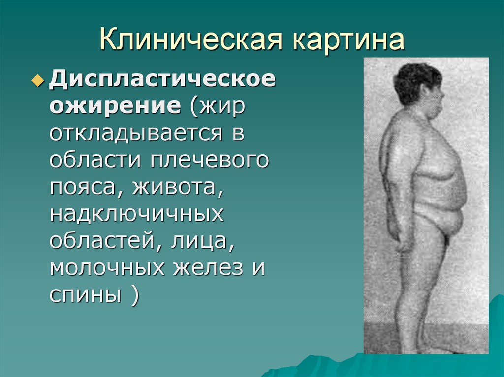 Клиническая картина ожирения