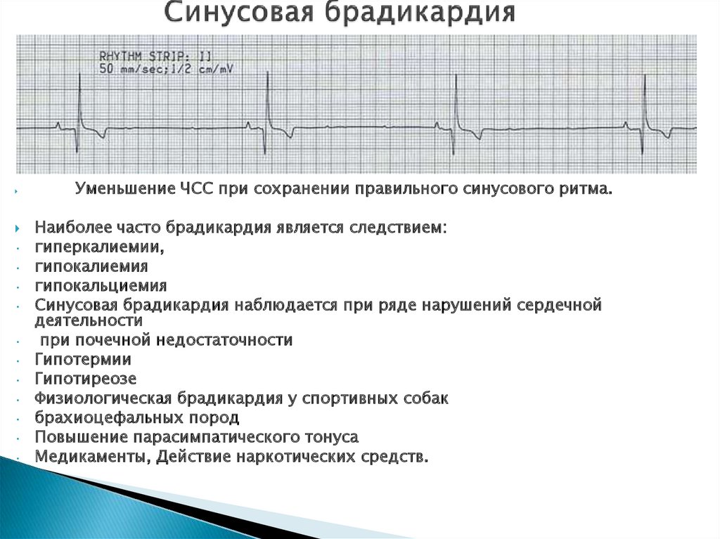 Что такое брадикардия простыми словами. БПВЛНПГ синусовая брадикардия. Синусовая брадикардия часто наблюдается:. ЭКГ гиперкалиемия брадикардия. При синусовой брадикардии число сердечных.