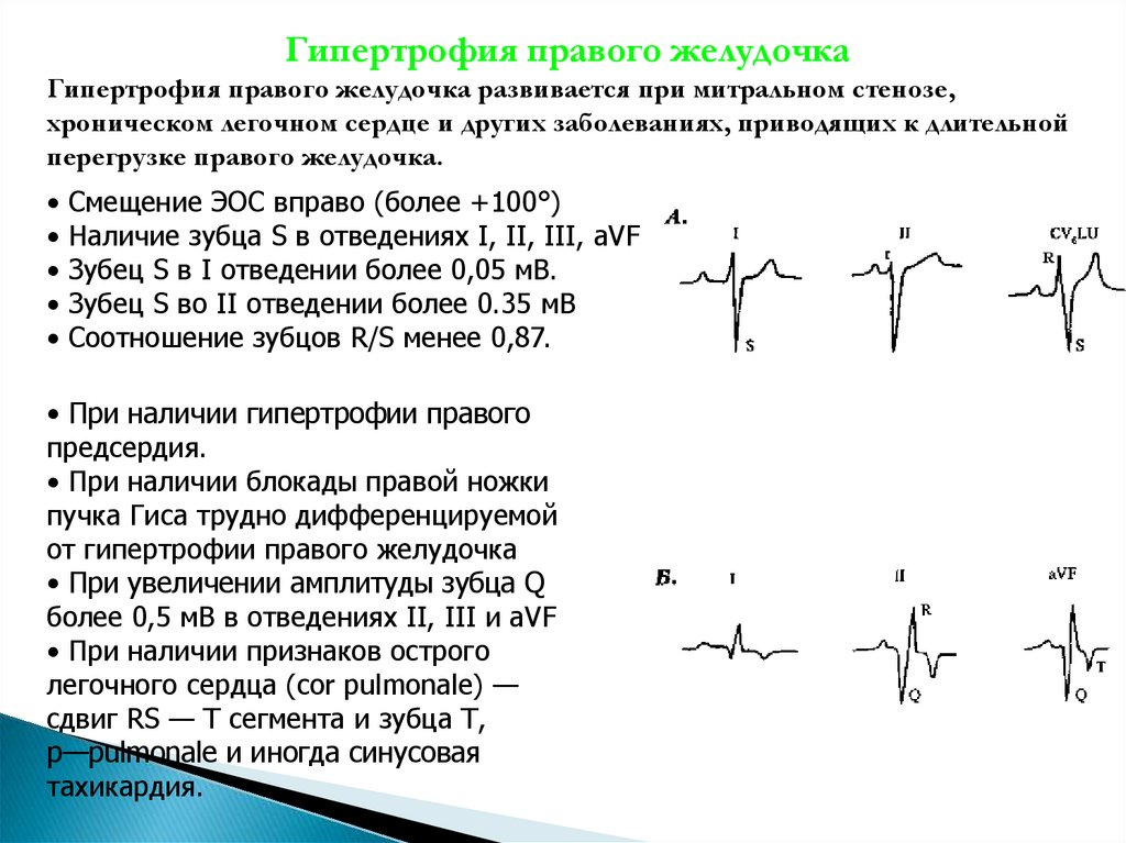 Гипертрофия правого желудочка