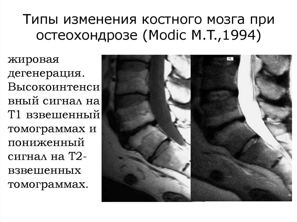Типы изменения костного мозга при остеохондрозе (Modic M.T.,1994)