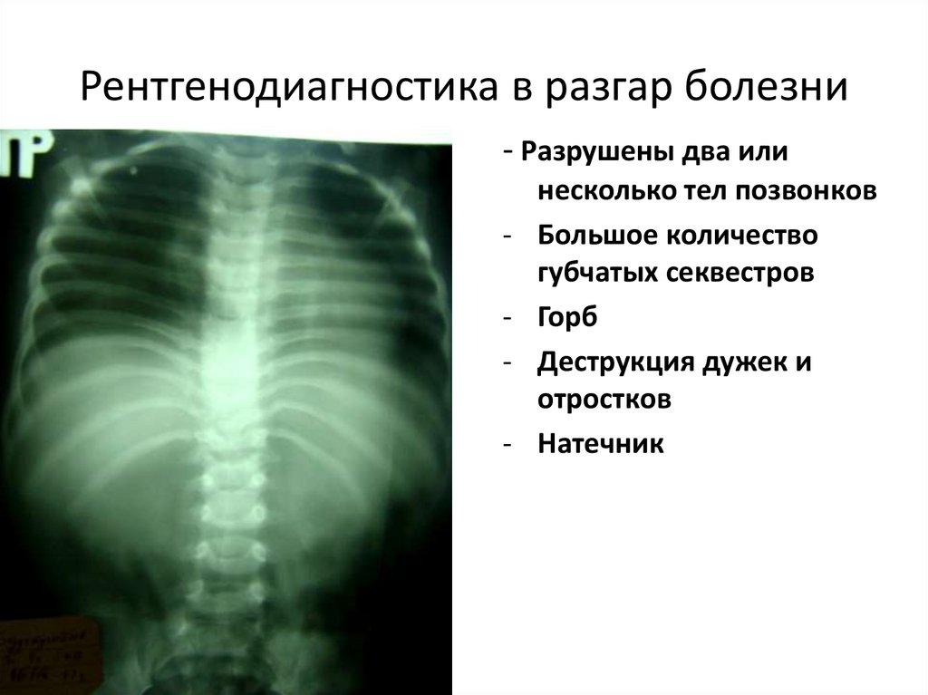 Рентгенодиагностика в разгар болезни
