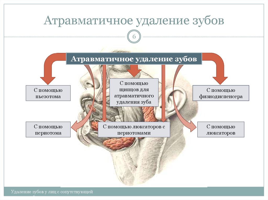 Атравматичное удаление зубов