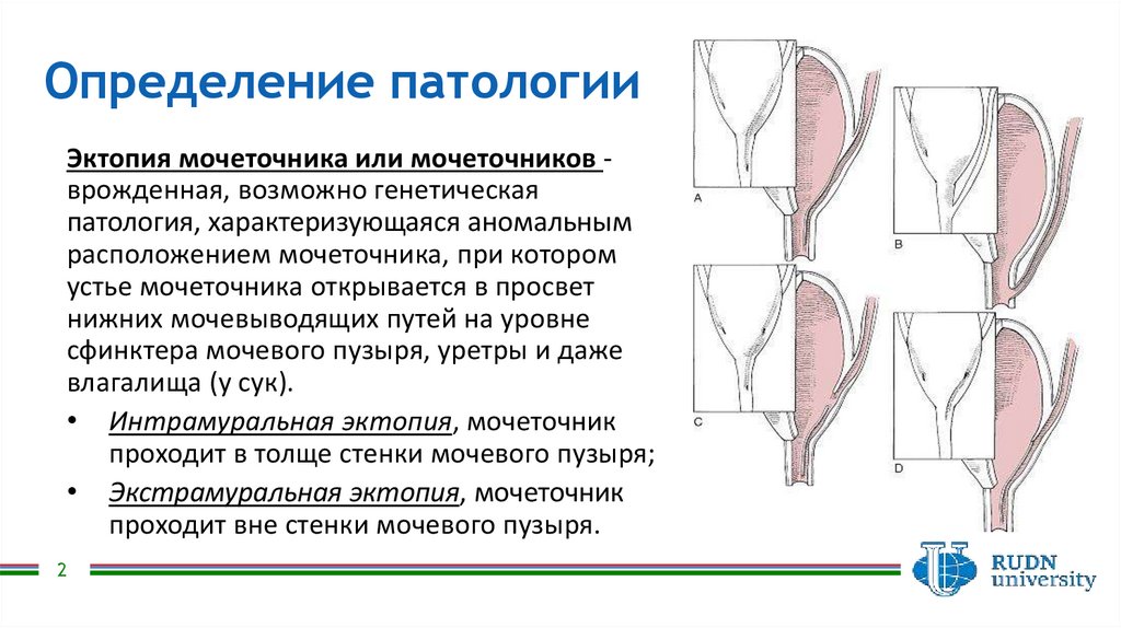 Эктопия причины. Эктопия устья мочеточника. Эктопия мочевого пузыря.