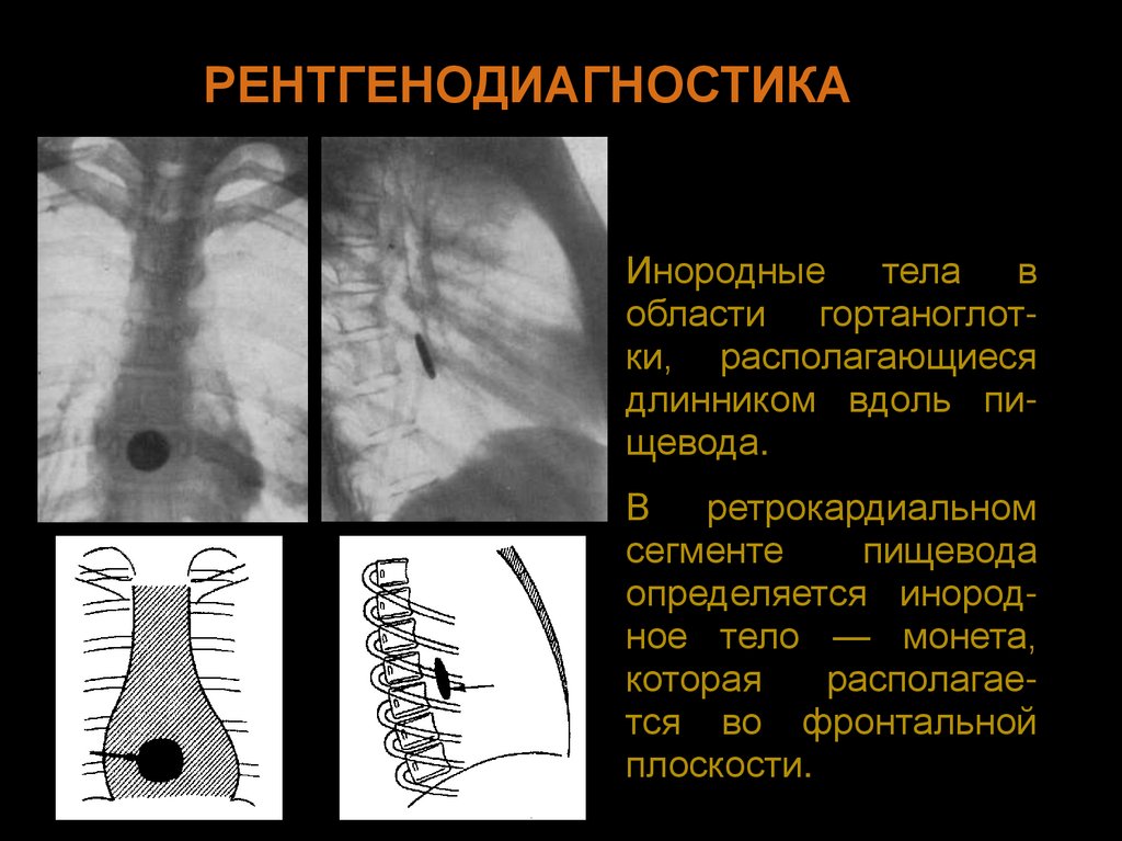 Презентация инородные тела жкт