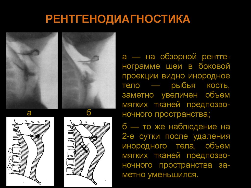 Презентация инородные тела жкт