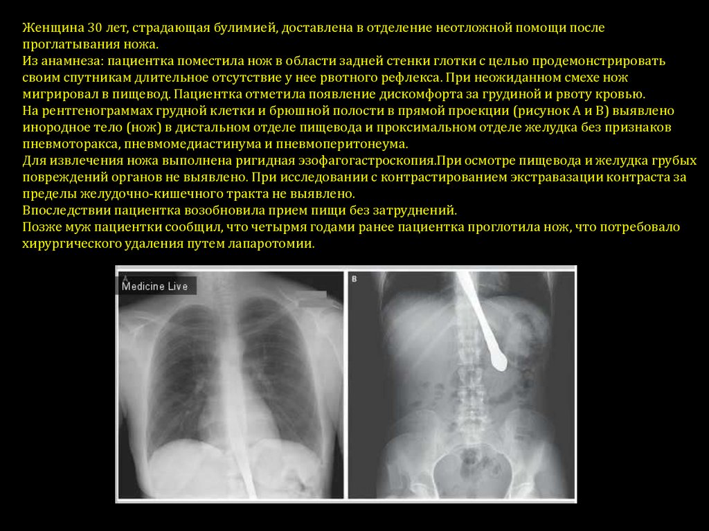 Инородное тело жкт карта вызова скорой медицинской помощи