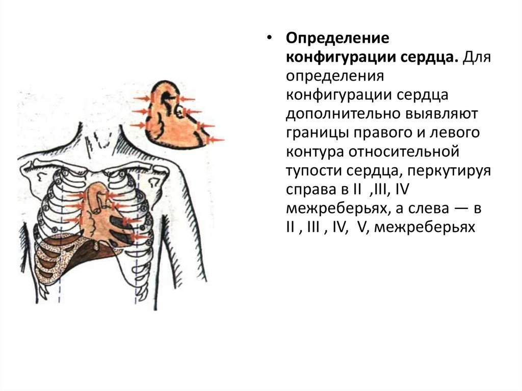 Перкуссия сердца схема