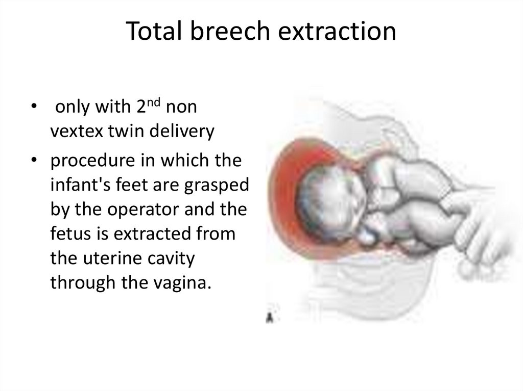 presentation breech extraction