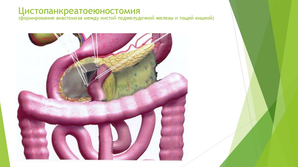 Омега при панкреатите можно. Продольная панкреатоеюностомия. Продольный панкреатоеюноанастомоз. Цистопанкреатоеюностомия. Цистопанкреатоеюностомия по ру.