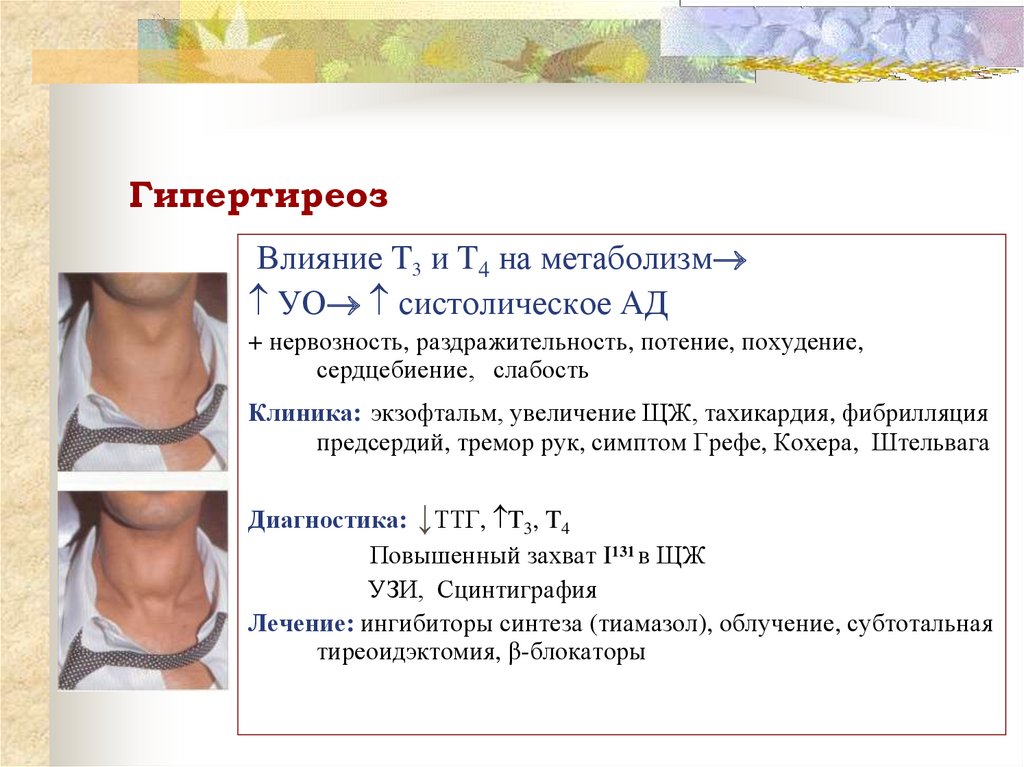 Гипертиреоз у детей презентация