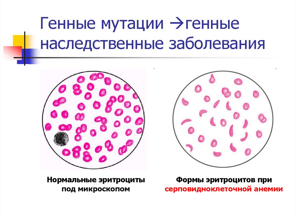 Рождение ребенка с серповидноклеточной анемией вид изменчивости