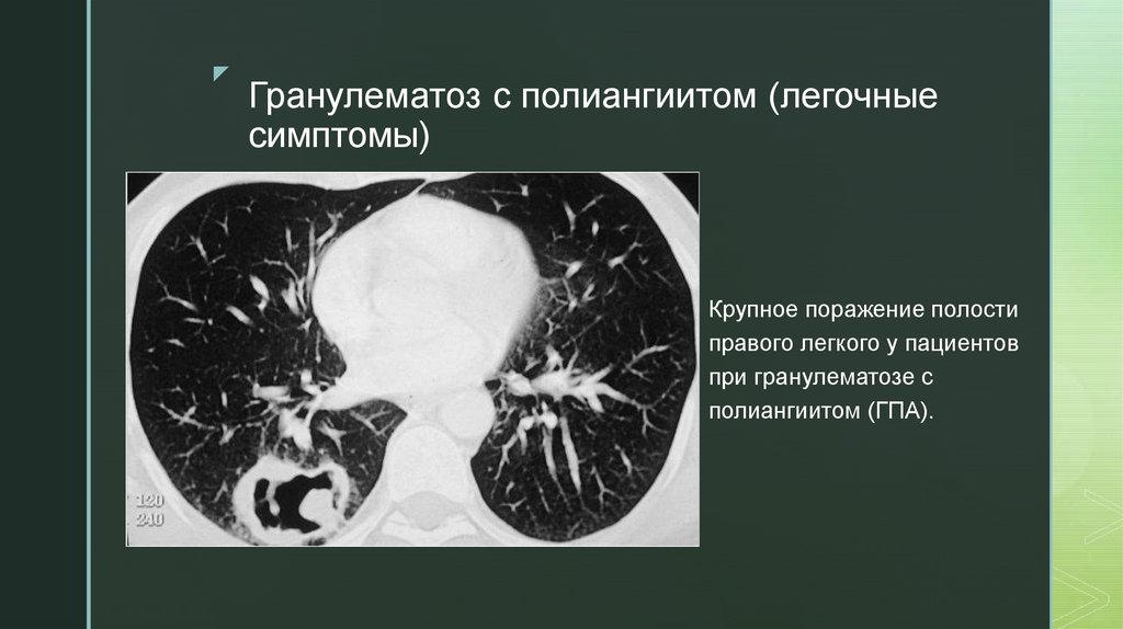 Хронический гранулематоз. Гранулематоз с полиангиитом Вегенера. Неспецифический гранулематоз.