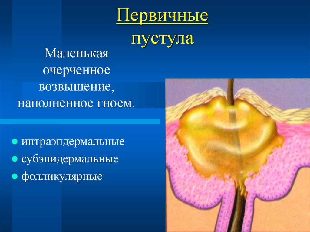 Первичные пустула