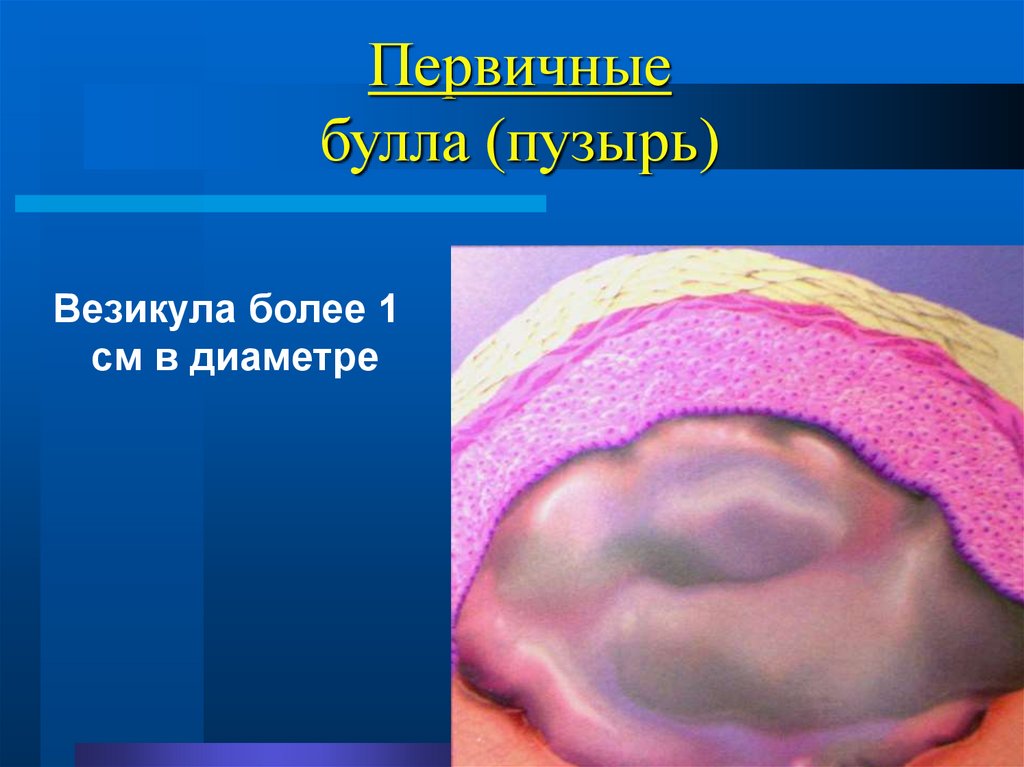 Первичные булла (пузырь)