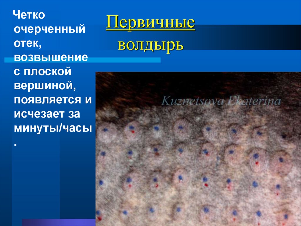 Первичные волдырь