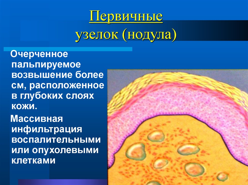 Первичные узелок (нодула)