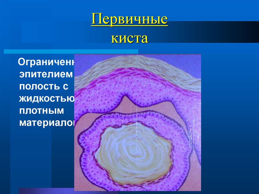 Первичные киста
