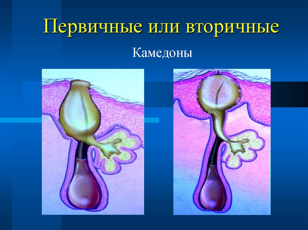 Первичные или вторичные