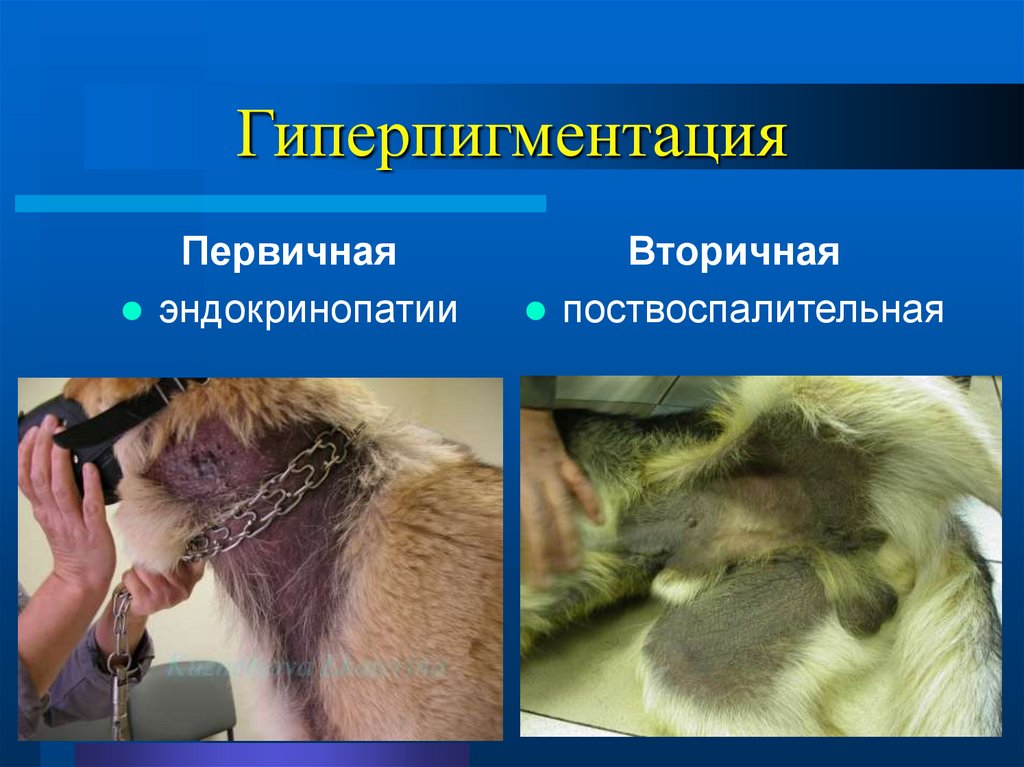 Гиперпигментация