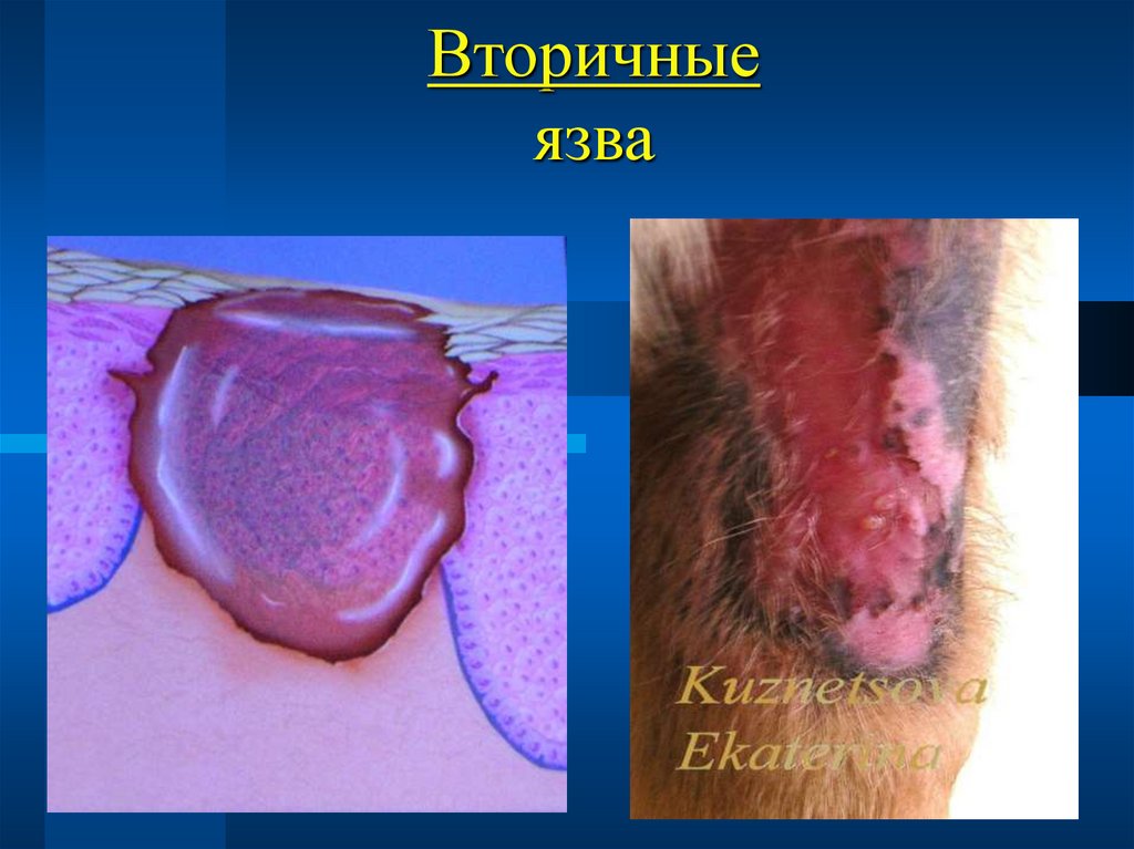 Вторичные язва