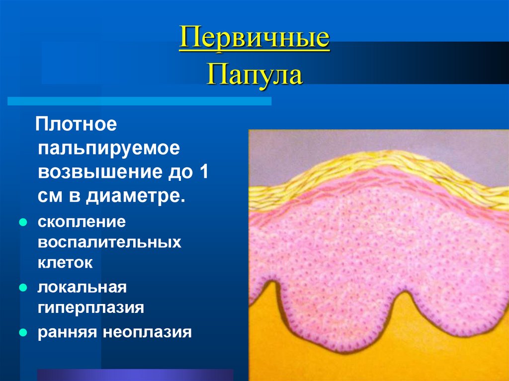 Первичные Папула