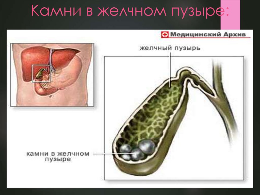 Желчекаменная болезнь картинки для презентации