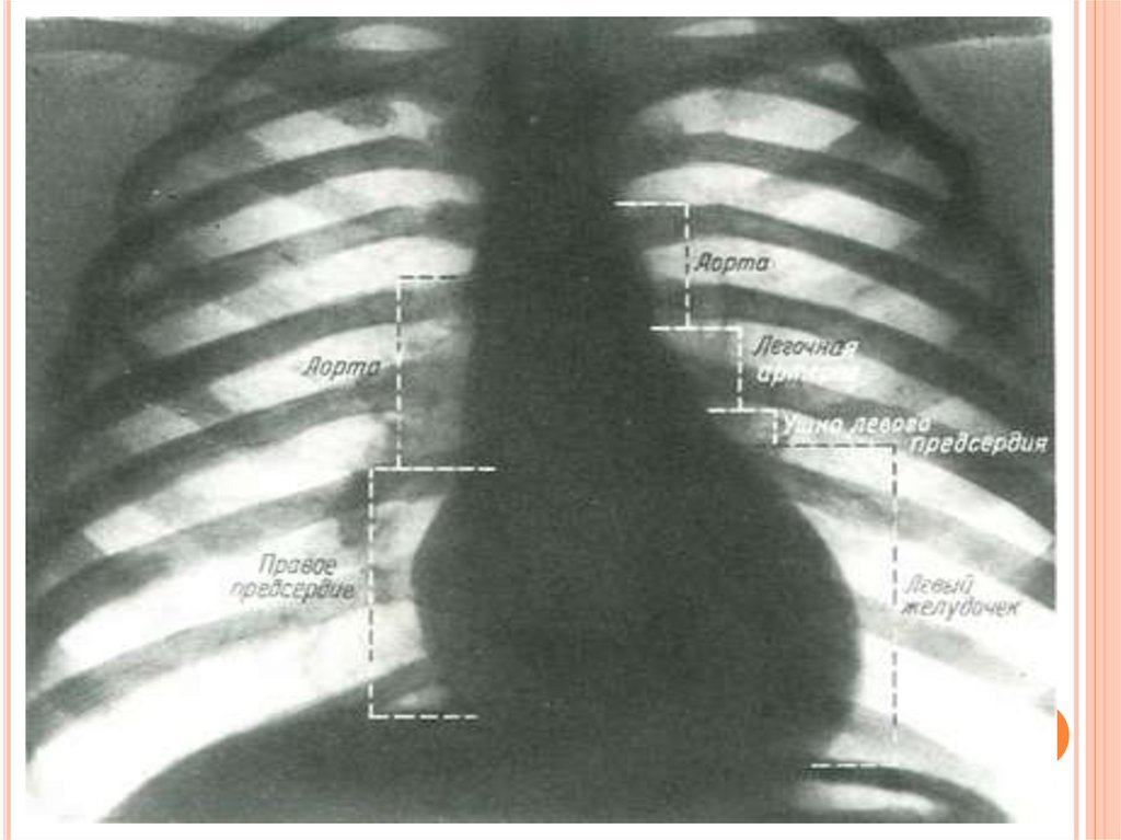 Рентген сердца. Рентген анатомия клапанов сердца. Рентген сердца в прямой проекции. Легочное сердце на рентгенограмме. Рентгенограмма сердца в норме.