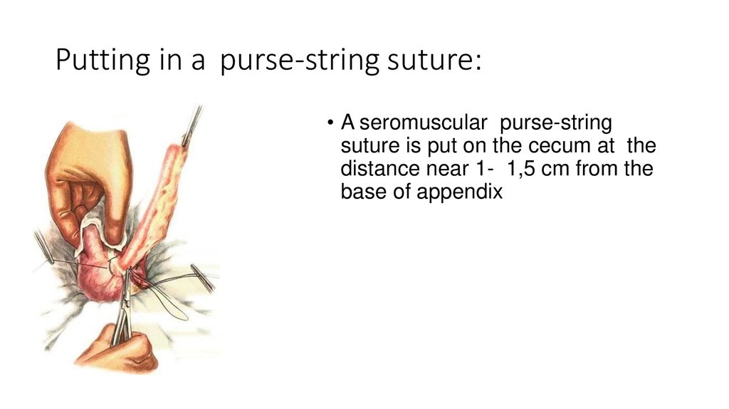 Previous suture method. a Purse string suture. b Multiple stitches in a...  | Download Scientific Diagram