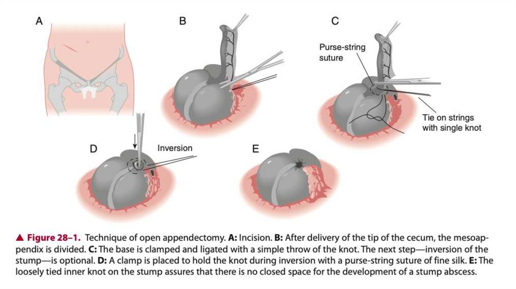 The Laparoscopic Approach for Perforated Appendicitis, Including Cases  Complicated by Abscess Formation | Journal of Laparoendoscopic & Advanced  Surgical Techniques