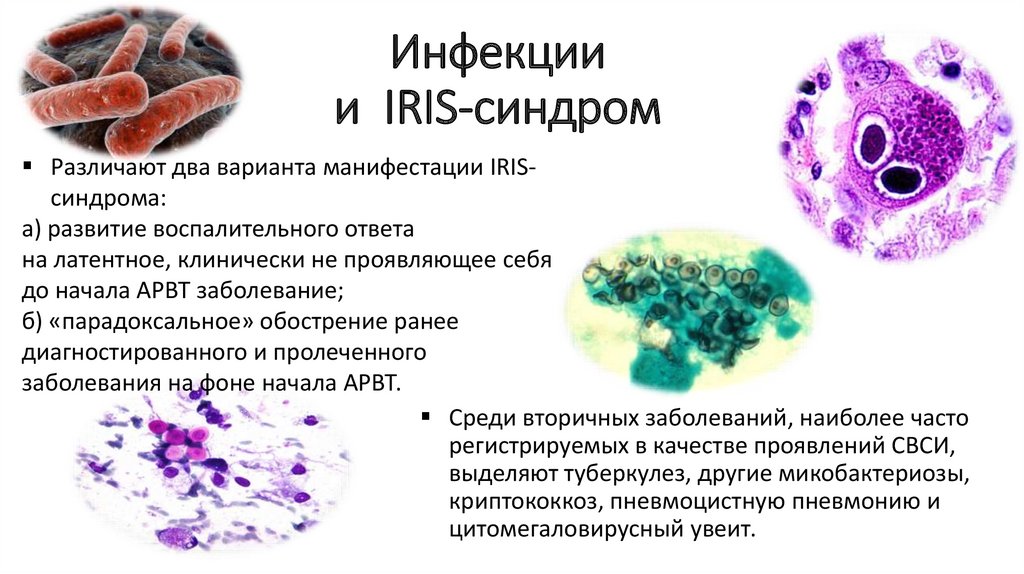 Клинико-патогенетические особенности развития и течения IRIS-синдрома у .