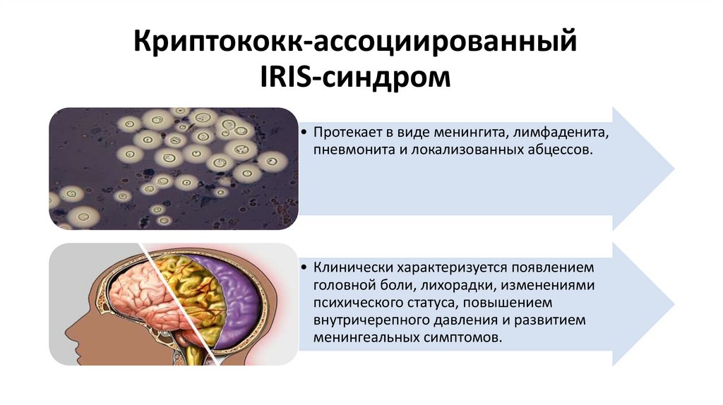 Клинико-патогенетические особенности развития и течения IRIS-синдрома у .
