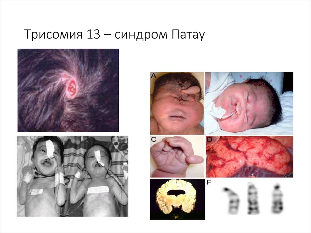 Трисомия 13 – синдром Патау