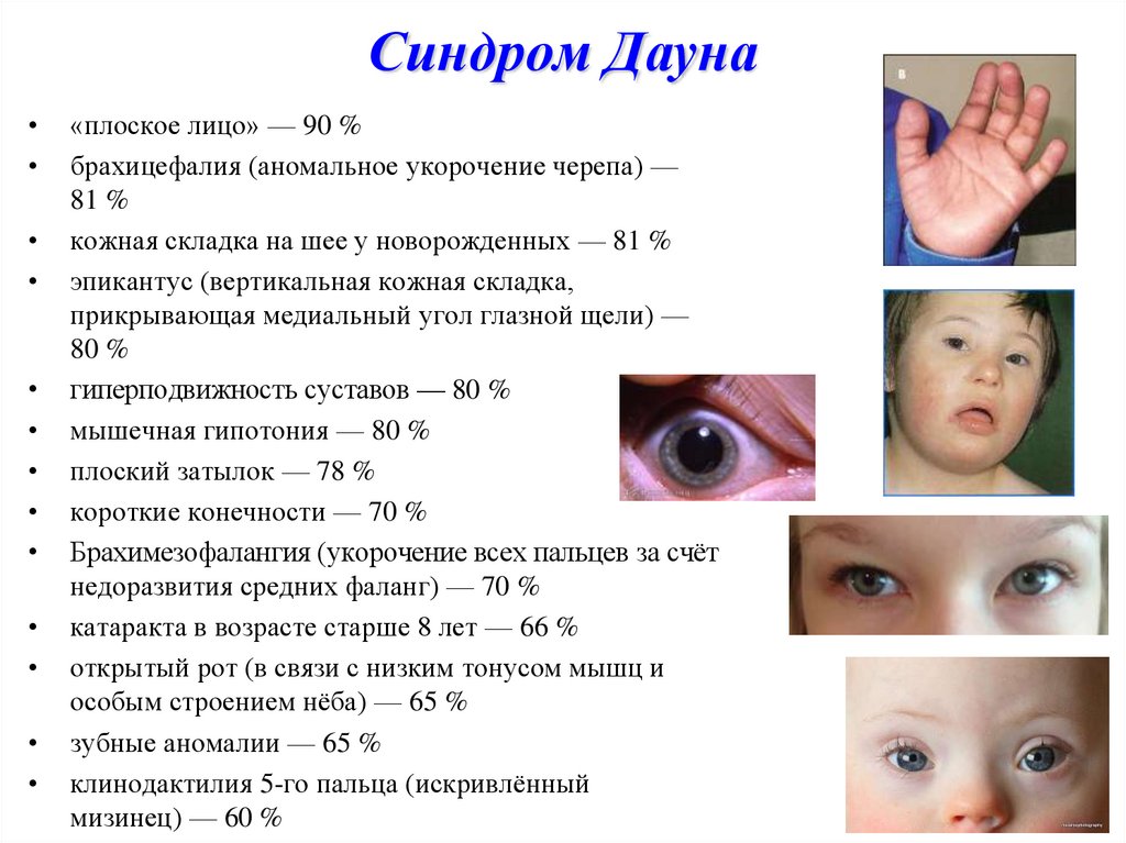 Варианты синдрома дауна. Эпикантус синдром Дауна. Эпикантус при синдроме Дауна. Разрез глаз при синдроме Дауна. Признаки синдрома Дауна у новорожденного.