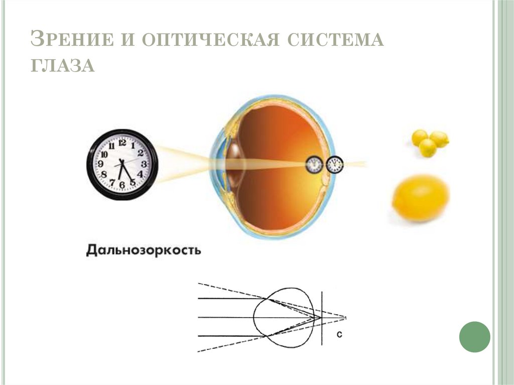 Дефекты оптической системы глаза