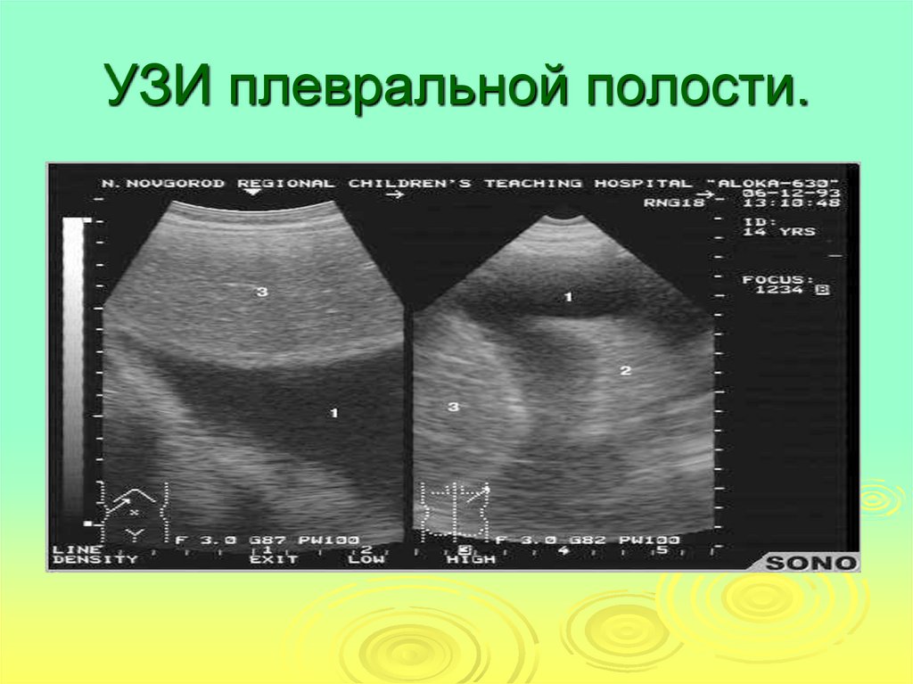 Узи полости. УЗИ плевральных полостей методика. Диагностер УЗИ плевральных полостей. Жидкость в плевральной полости слева на УЗИ. УЗИ плевральной полости легких.