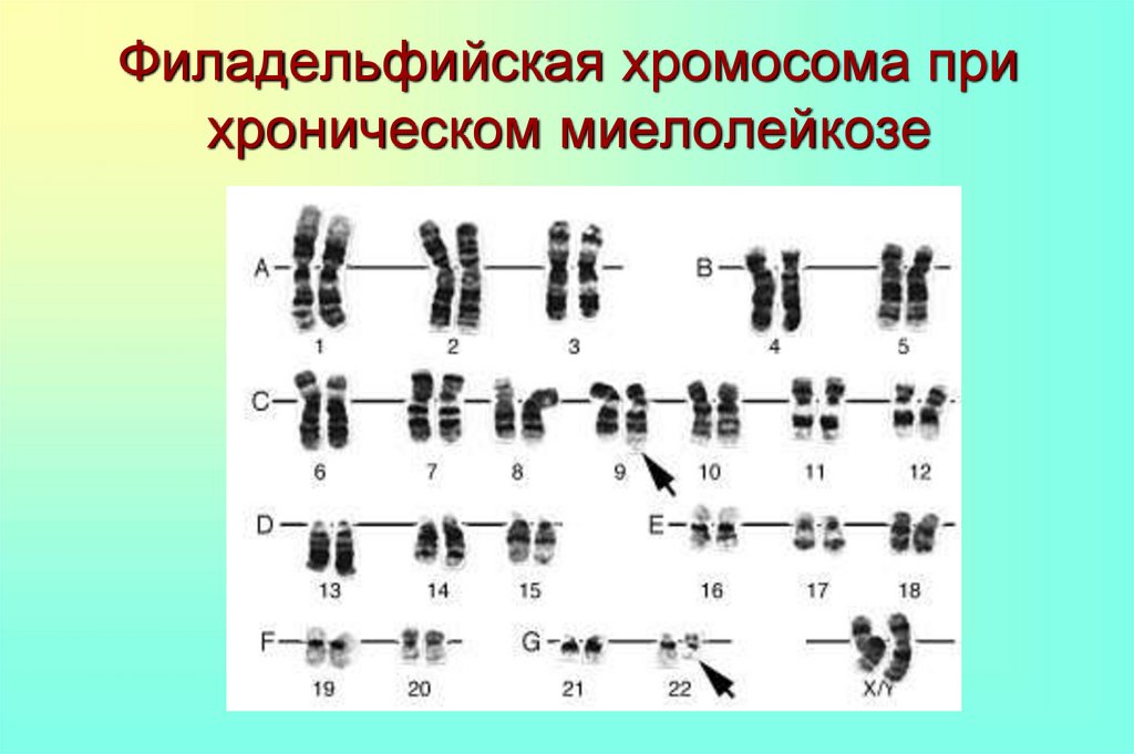 9 хромосома. Филадельфийская хромосома. Филадельфийская хромосома характерна для. Формула филадельфийской хромосомы.