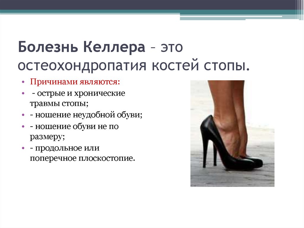 Болезнь Осгуд-Шляттера - презентация онлайн