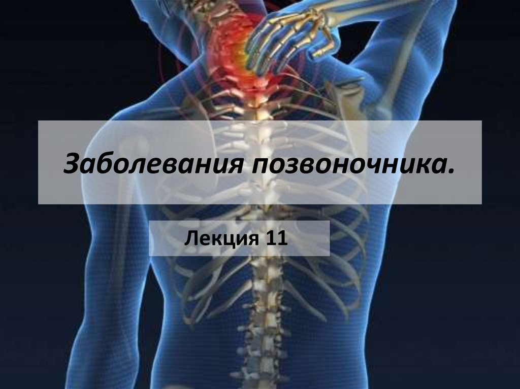 Поражение спинного. Болезнь спины на букву м. Калидинова Алина болезнь позвоночника.