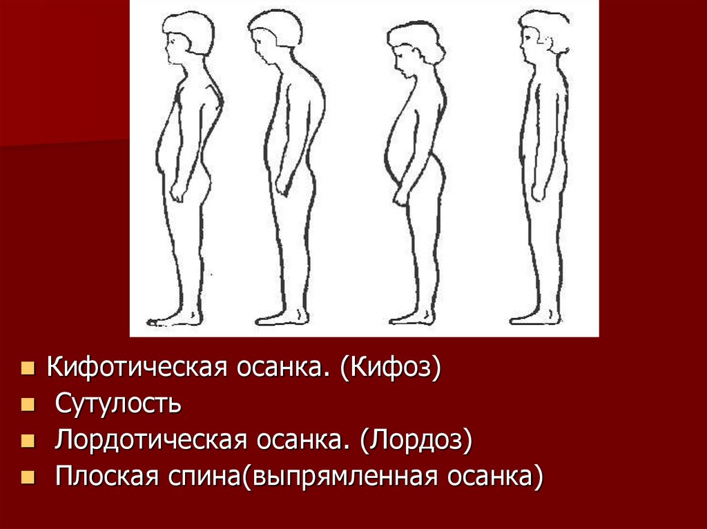 Плоскостопие искривление позвоночника