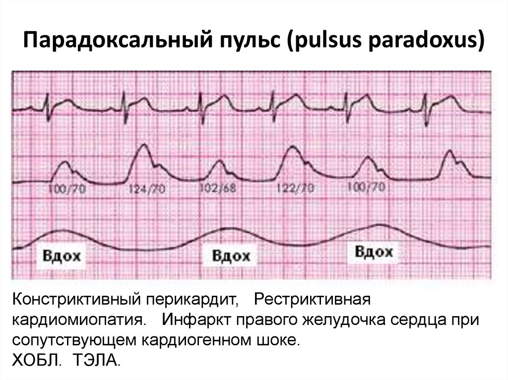 Почему пульс разный. Нормальный пульс схема. График пульса здорового человека. Нормальная диаграмма пульса. Нормальный график биения сердца.