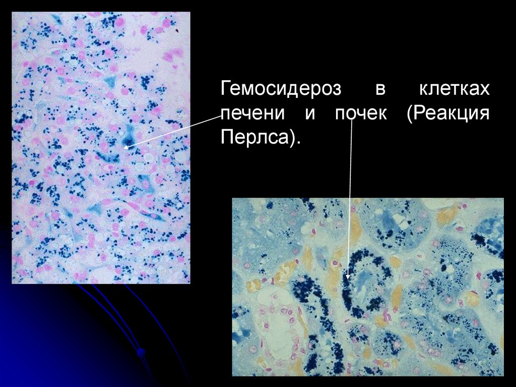 Реакция перлса