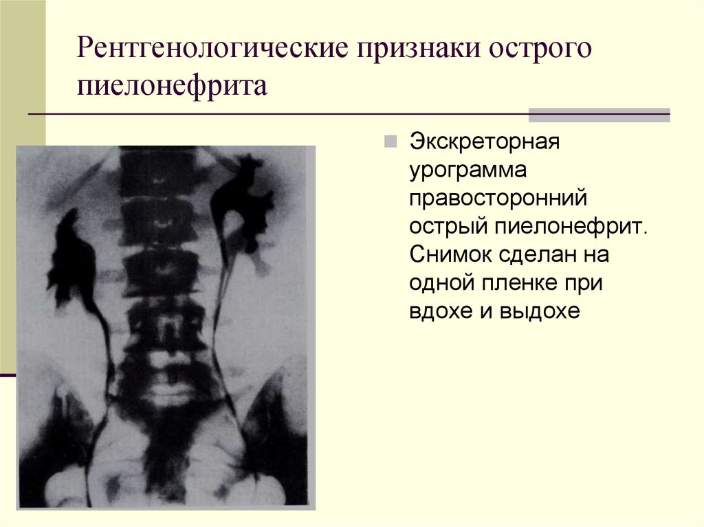 Рентгенологические признаки. Острый пиелонефрит рентгенологические признаки. Острый пиелонефрит рентген. Пиелонефрит рентген признаки.