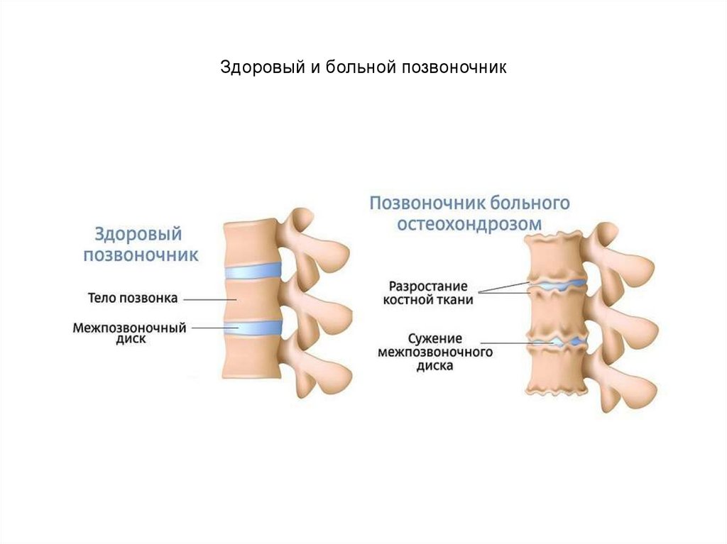 Остеохондроз позвоночника презентация