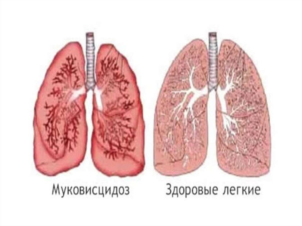 Кистозный фиброз презентация